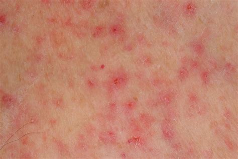 Heat (Prickly) Rash: Pictures and Quick Treatment