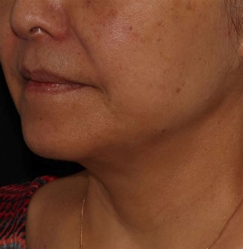 Endolift London | Skin Tightening Treatment | PHI Clinic