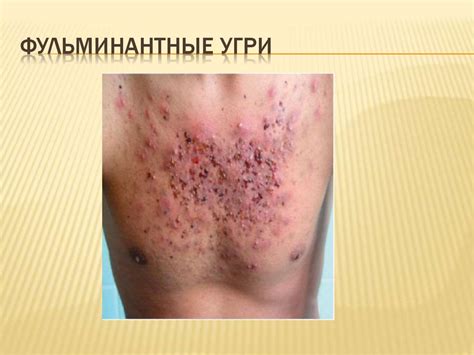 Вульгарные угри. Акне или угревая болезнь - презентация онлайн