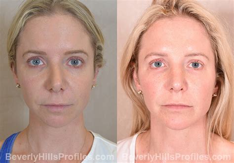 Chin Implants Before & After Photos | Los Angeles