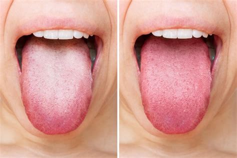 Lingua Normal E Lingua Doente