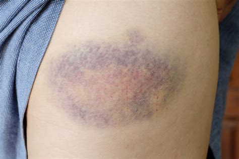 Bruises Blood Clots | American Blood Clot Association