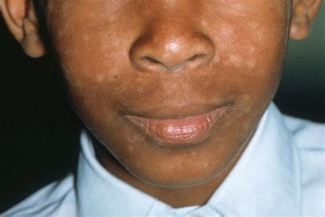 In Pictures: Guide to Seborrheic Dermatitis