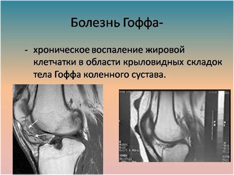 Причины возникновения боли под коленом, диагностика, лечение