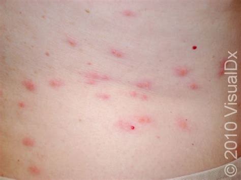 Bed Bug Bite Rash