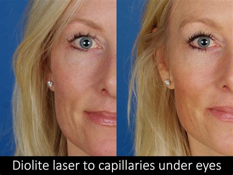 Laser Skin Treatments Before & Afters | Raval Facial Aesthetics | RMLA