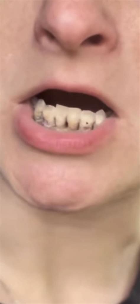 Her bottom teeth have deteriorated really fast. : r/Ashleystarrcasteel