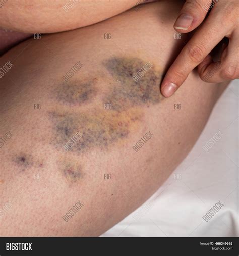 Treatment Bruises, Image & Photo (Free Trial) | Bigstock