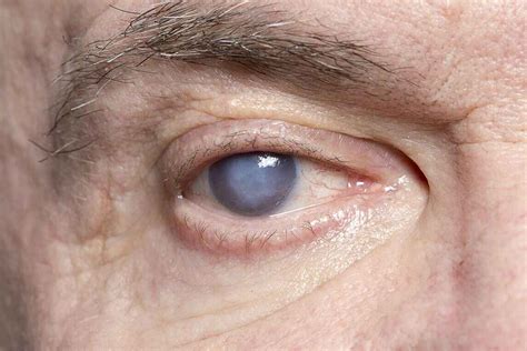 Cataract: What is Cataract Symptoms, Causes, Types, Treatment & Prevention