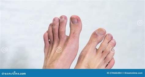 A Man S Toes Showing What Looks Like a Rash with Red Blotchy Skin. a Common Side Effect of Covid ...