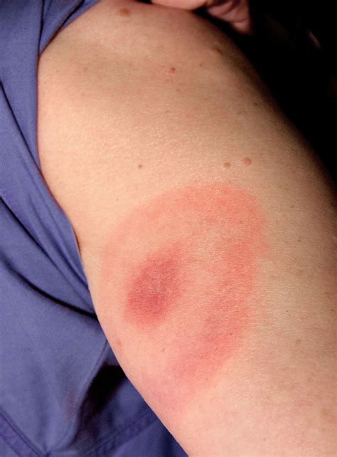 Rare Skin Diseases