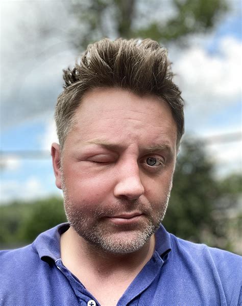 Wasp sting on eyelid, just 2mm from my eyeball. It hurts…badly. : r