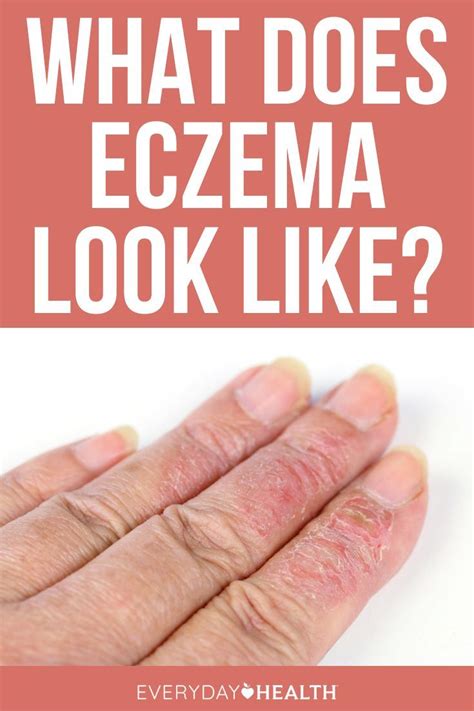 Eczema: Symptoms, Treatment, Causes, More | Eczema, Eczema symptoms ...