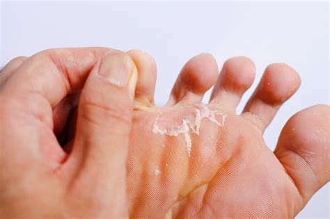 Mycose entre les orteils chez l'homme et la femme