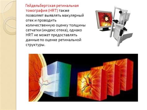 Презентация - Диабетический макулярный отек » Привет Студент!