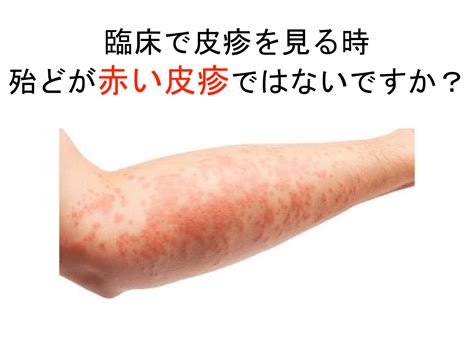 赤い皮疹の見方／考え方／鑑別〜炎症、腫瘍、血管分けて考える〜 | Antaa Slide