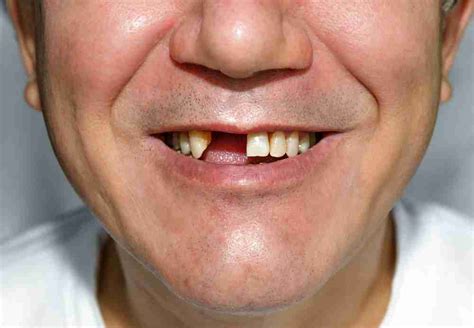 agenesia – Estudi Dental Barcelona