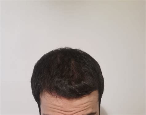 Minoxidil with Finasteride Topical Solution | Dualgen-15 With PG Plus