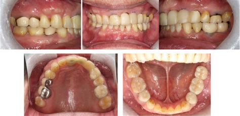 The intraoral photographs after treatment. | Download Scientific Diagram