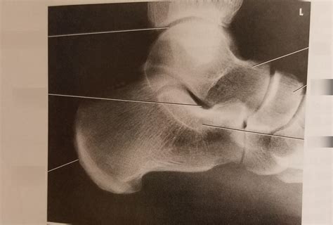 ankle lateral diagram quizlet