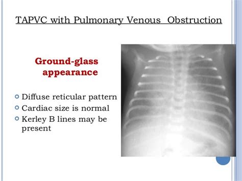 TOTAL ANOMALOUS PULMONARY VENOUS CONNECTION (TAPVC)