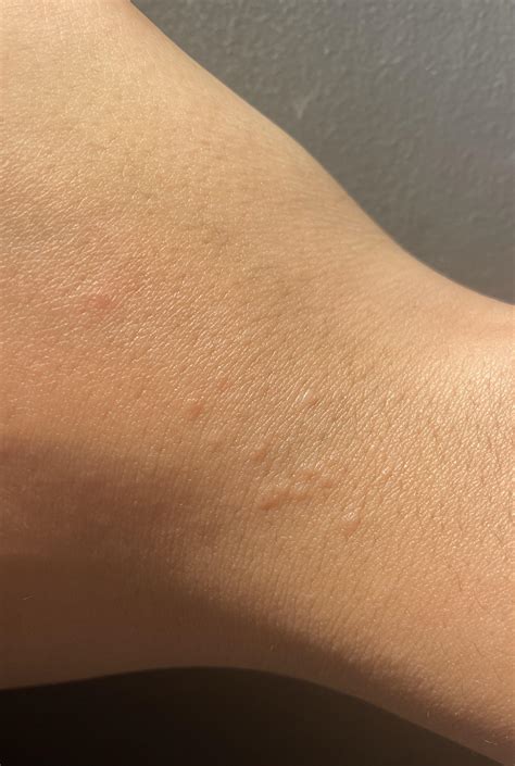 84 best r/scabies images on Pholder | Face is COVERED in very long burrows.
