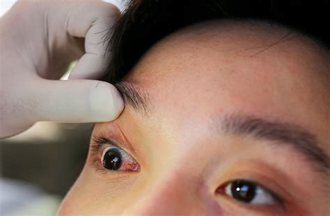 Is It Pink Eye or Something Else? Understanding Eye Symptoms