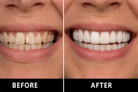 dental veneers     process rank  dentist