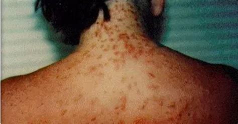 Sea Lice Outbreak Causing Discomfort On Beaches - Good Day Sacramento