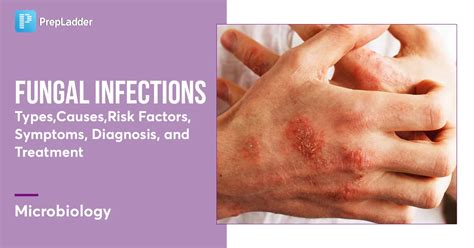 Fungal Infections: Types, Causes, Symptoms, Diagnosis & Prognosis