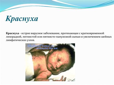 Детские инфекционные заболевания: корь, краснуха, ветряная оспа ...