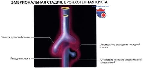 КТ при бронхогенной кисте