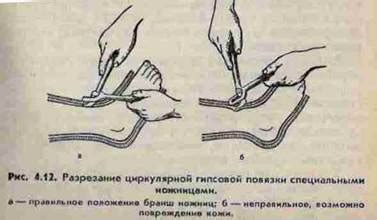 Техника снятия гипсовой повязки