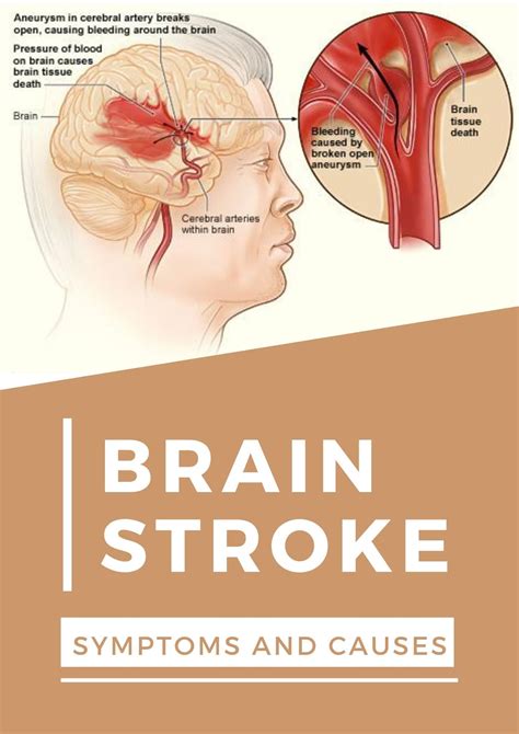 Brain Stroke - Symptoms and causes - All About Health - Diseases ...