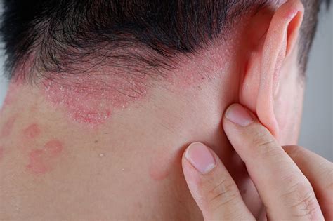 Psoriazis - cauze, simptome, tratament