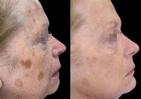 Harmony XL Pro - Ridgeline Aesthetics - A Premier Med Spa Experience