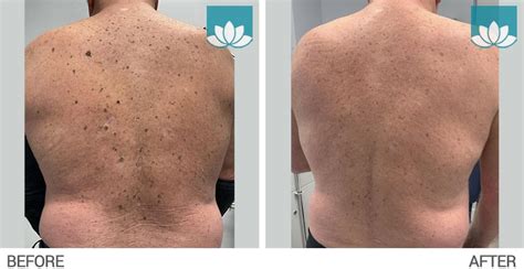 seborrheic keratosis treatment  south miami