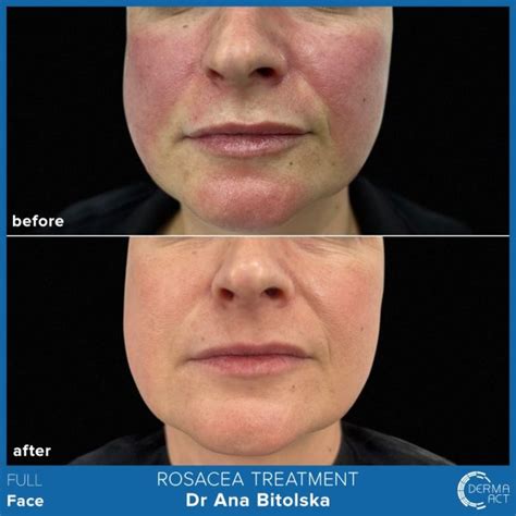 Розацея - причини, диагностика и лечение | Derma-Act