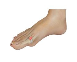 cheilectomy procedure  york ny hallux rigidus staten island