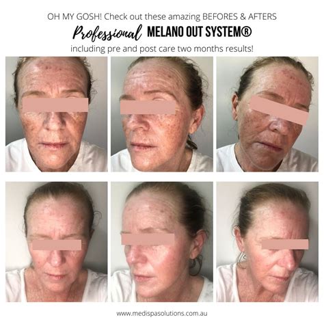 PROFESSIONAL MELANO - MEDISPA SOLUTIONS