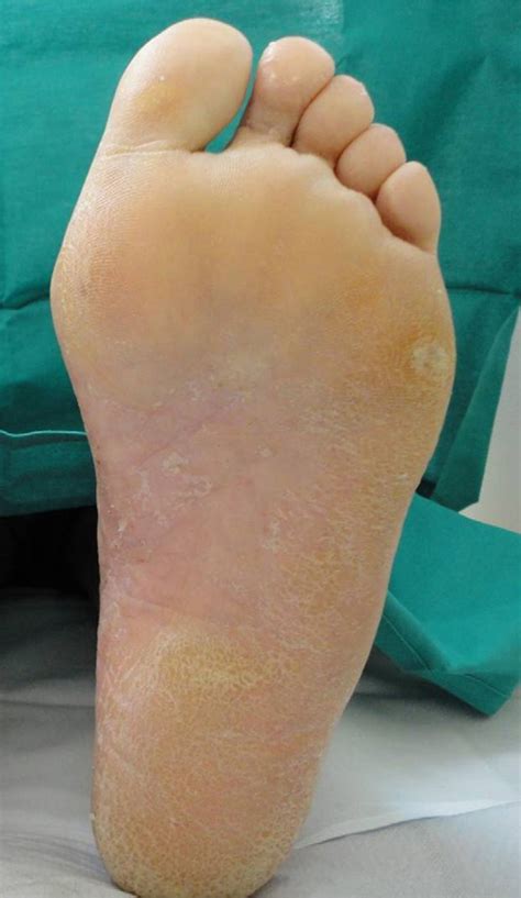 Ustekinumab for the Treatment of Palmar-Plantar Pustulosis | Actas