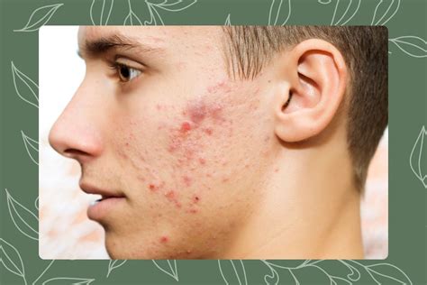 Fungal Acne vs. Bacterial Acne | Acne Types