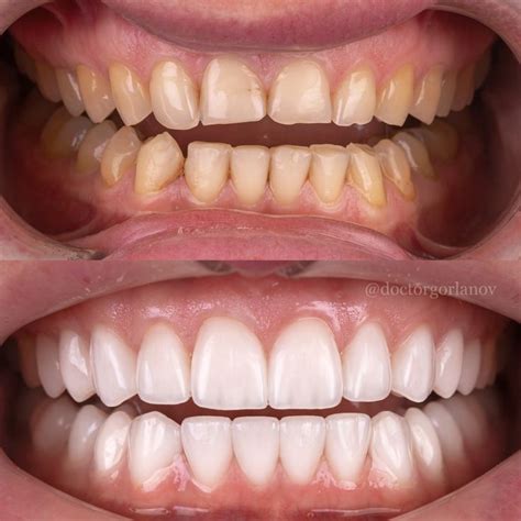 #виниры #dental #dentist #veneers #стоматология #улыбка Dental Social ...