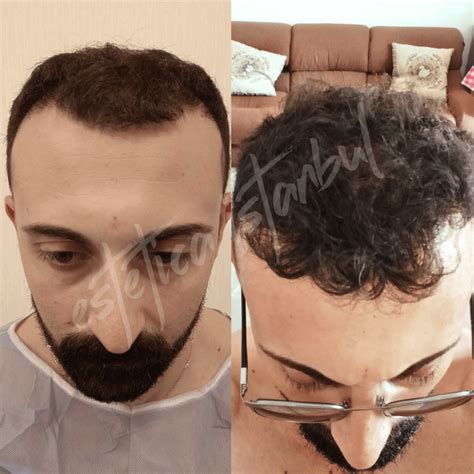 Hair transplant Turkey Before After - Estetica Istanbul