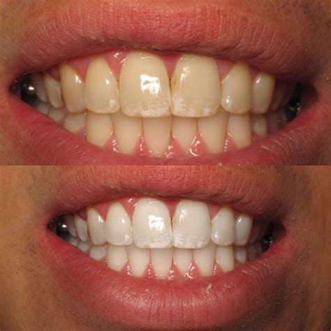 Whitening Teeth Enamel at Ina Pfarr blog