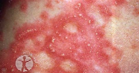 Pustuloderma image