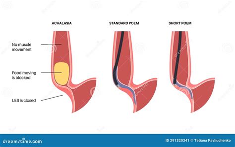 POEM medical poster stock vector. Illustration of incision - 291320341