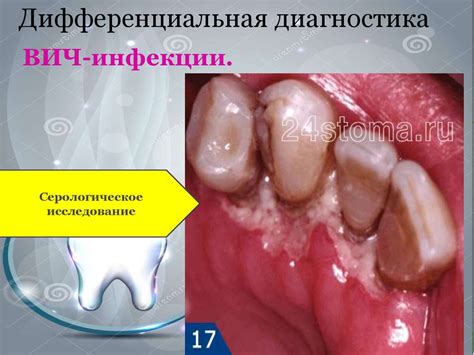 Язвенно-некротический гингивостоматит Венсана - презентация онлайн