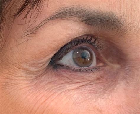 Plasma Lift Resurfacing | Sydney Permanent Makeup Centre | Five Dock