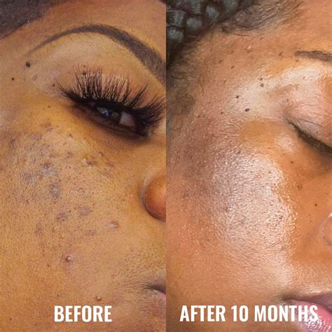 Discoloration Correcting Serum